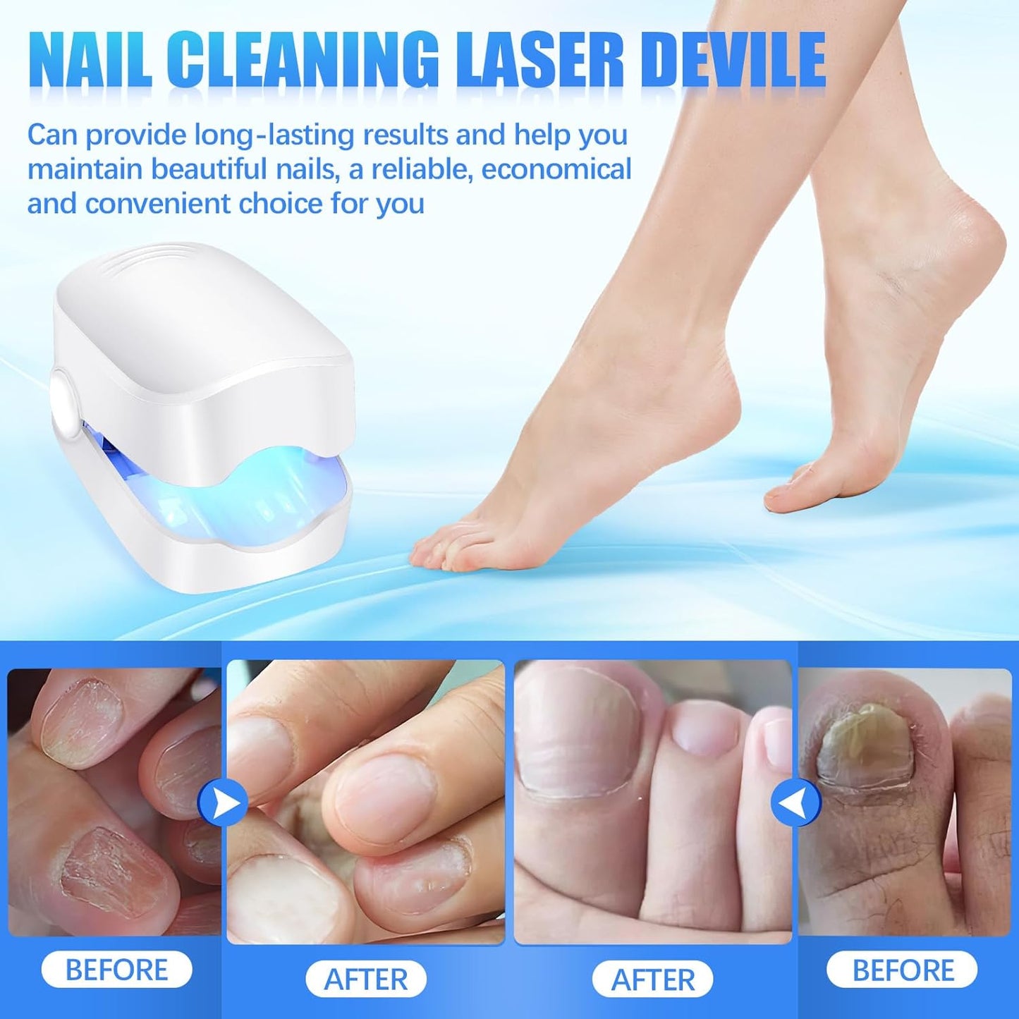 Rechargeable Nail Fungus Laser ? Anti-Fungal Device for Toenails, Hands & Feet (Home Use)
