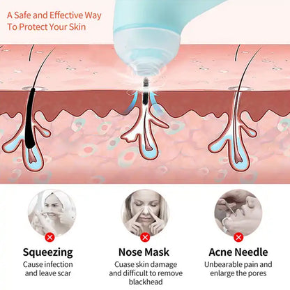 Mini Handheld Vacuum Blackhead Remover ? Facial Massage & Spot Lifting (1 Pc)